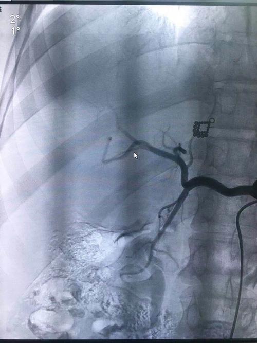 术前造影显示:巨大肝血管瘤,直径约15厘米