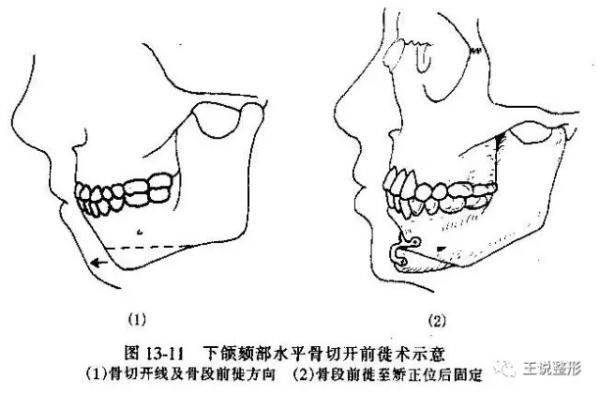 单知道颏部美学的重要性还不够你还需要知道隆下巴的方法
