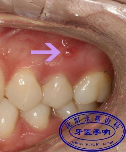 牙床肉发白图片