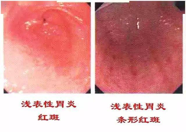 慢性浅表性胃炎,需要治疗吗?