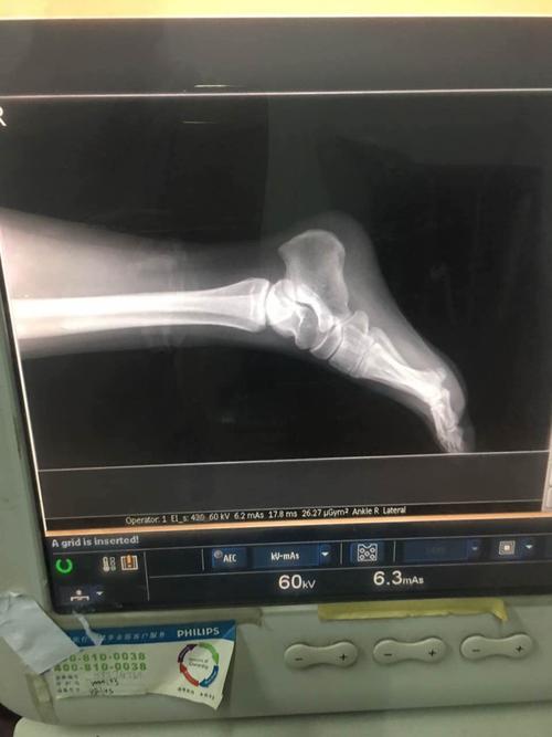 我还需不需要拍ct