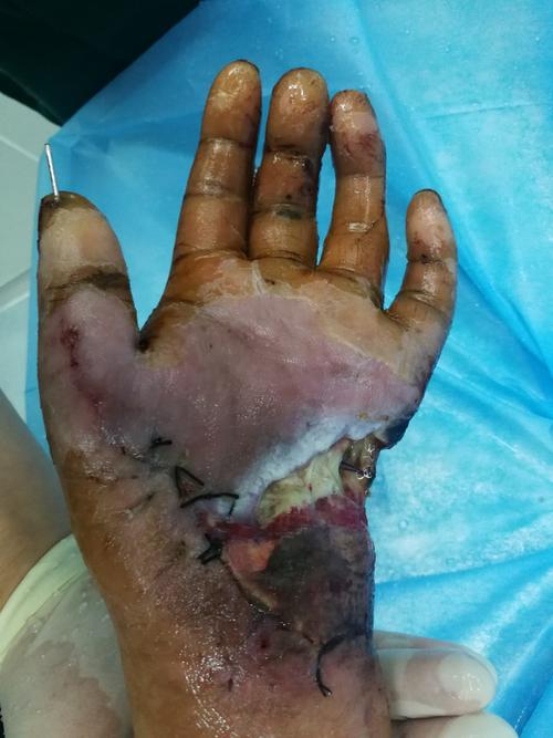 骨间前动脉穿支血管带蒂皮瓣