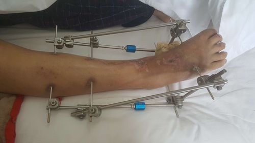 现术后三年,右大腿,右小腿外固定架已去除9个月,扶双拐可行走,右下肢