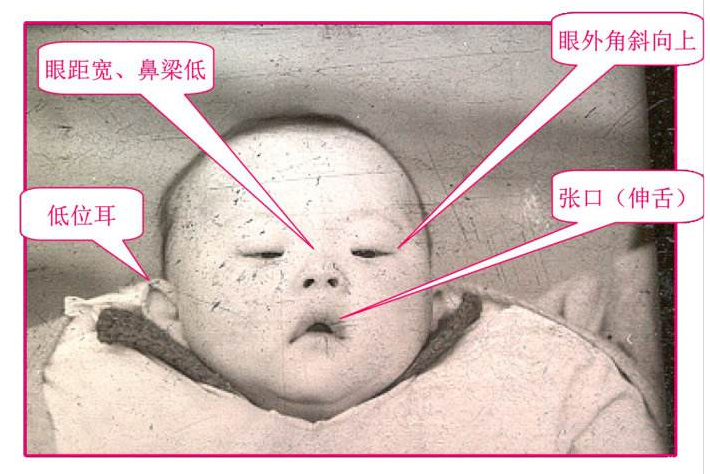 唐氏综合征如何预防?做好产前筛查和诊断,生命才会更完美!