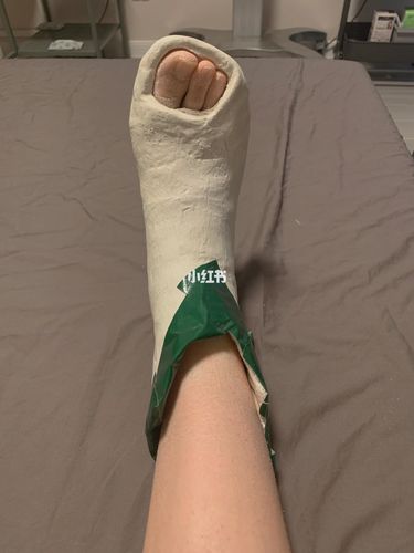 记录骨折第33天 手动截短石膏_筷子_靴子_踝靴_骨折_医疗健康_医疗
