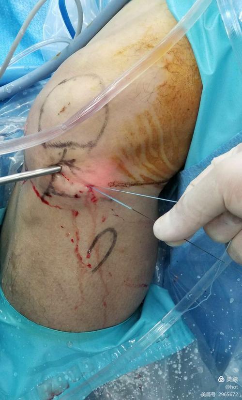 完全盘状半月板复杂型撕裂成型缝合修补术