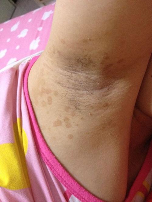 右侧腋窝处长了一个疙瘩 右侧胳肢窝下长了一个硬疙瘩 右侧鼻梁的鼻沟