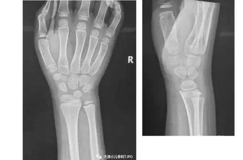 孩子只是摔倒,扭了一下为什么要打石膏?