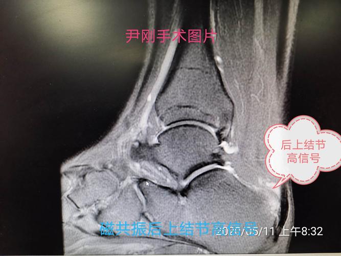 磁共振示跟骨后上结节高信号