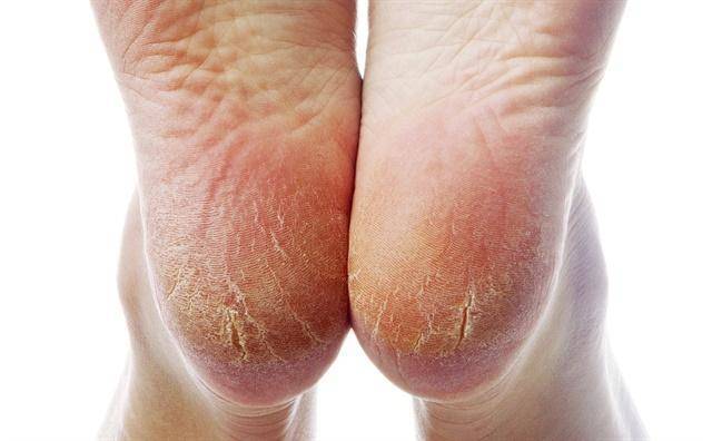 教你四步搞定脚部干裂,裂口!