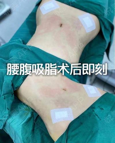 广州荔医案例腰腹吸脂恢复记录分享