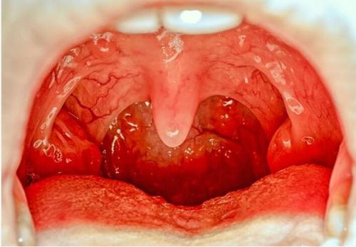 急性细菌性咽炎扁桃体炎的治疗原则