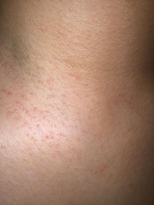 有点蓝色的印记,没带项链,之前吃了一点芒果但是一般对芒果不过敏