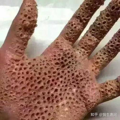 手密集恐惧症图片