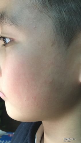 五岁小孩脸上不痛不痒的湿疹
