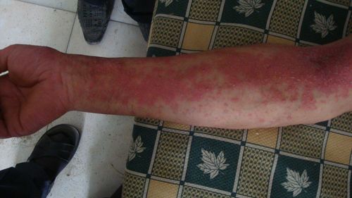 腹股沟以上的皮肤病变,请诊断