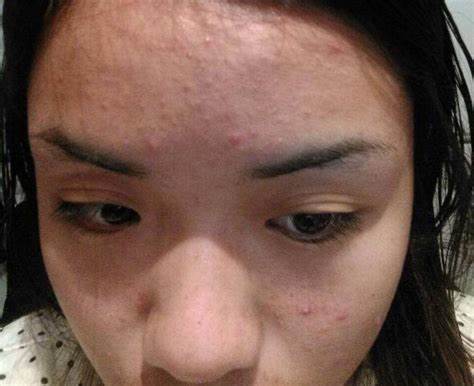 夏天长痘痘其实不用怕,你在找的祛痘方法这里都有,值得收藏