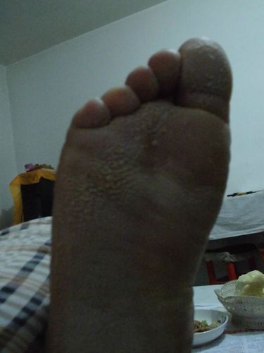 脚底有麟纹,有出汗迹象,涂抹过达克宁,效