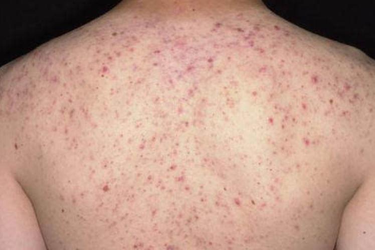 为什么前胸和后背会长痘痘