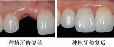 什么是瑞士百达种植牙?