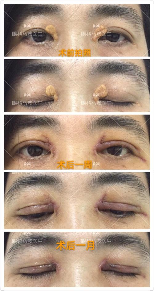 更新第2季眼皮上长了黄斑是怎么回事图片案例篇