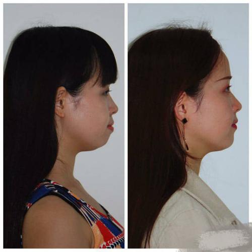 杨幂说拔智齿可以改变脸型,真的可以吗?网友:反正我是