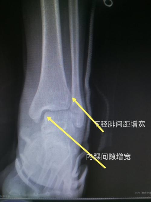 扭伤后致左侧踝关节疼痛,肿胀活动受限及左小腿疼痛,门诊dr片及ct