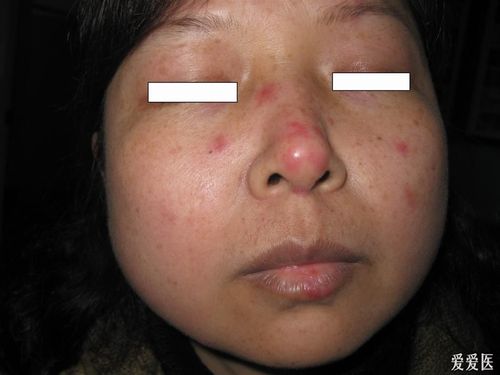 看图识病------------红斑狼疮 - 皮肤及性传播疾病讨论版 - 爱爱医