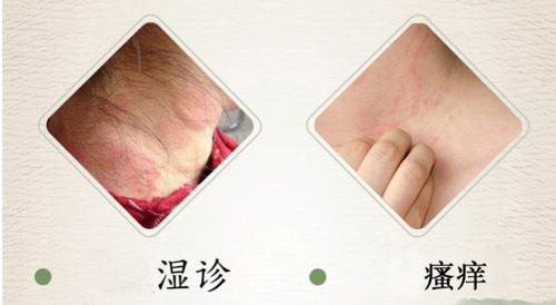 炎炎夏日,防治皮肤瘙痒有妙招!
