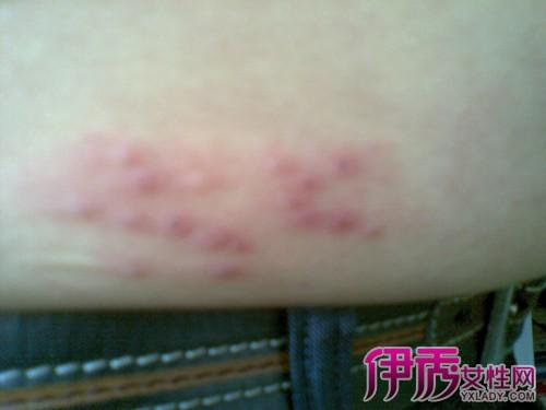 大腿根突然长好多小水泡 这是由病毒感染引起的带状疱疹