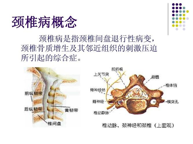 颈椎病概念 颈椎病是指颈椎间盘退行性病变, 颈椎骨质增生及其邻近