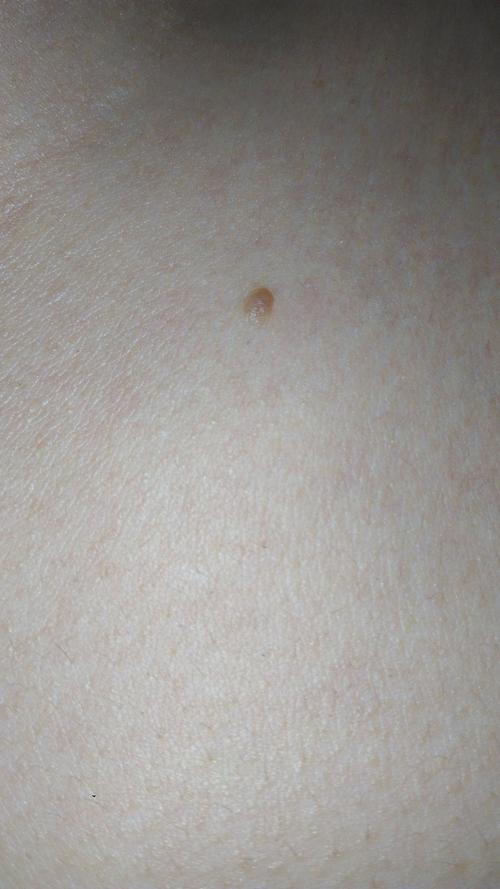 近来身上长了一些小肉疙瘩,感觉越长越大,请懂的老师看看是什么