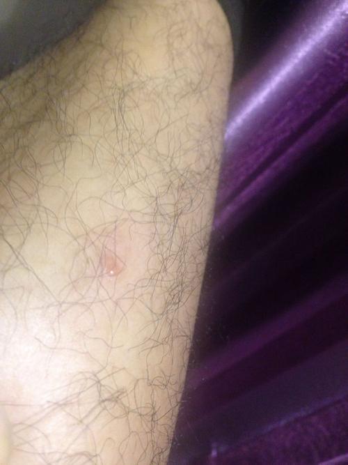 小腿上莫名长了个水泡,是什么东西