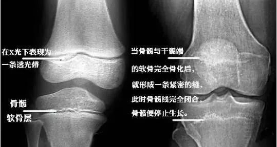 骨骺闭合之前怎么长高石家庄港大妇女儿童医院蔡西萍主任解答