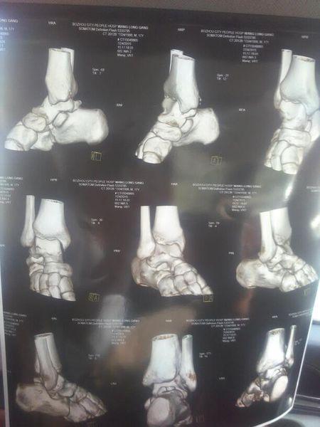 我脚踝双踝裂纹骨折九个月了,这是昨天拍的x光片和三维重建图,说的