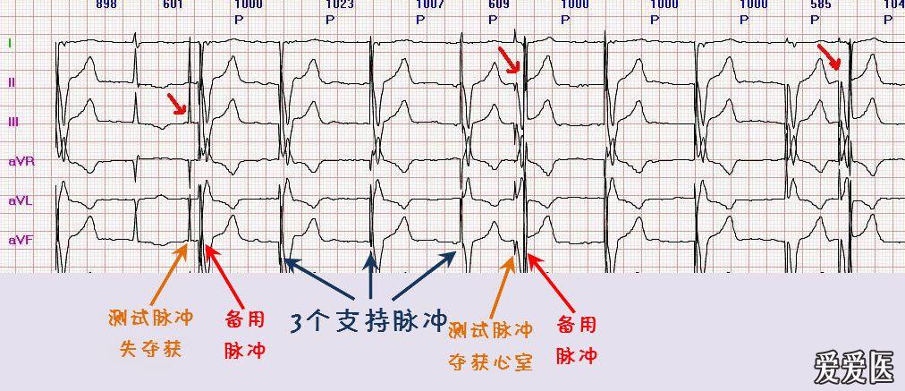 请高手看看这份起搏器心电图,急!