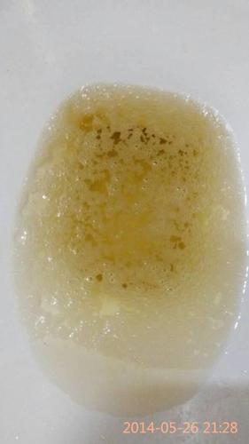 请丈夫帮忙看看尿液,情况持续一年多了.现在泡沫越来越多,看着都吓人.