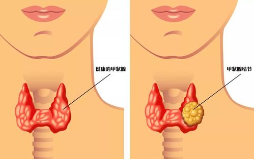甲状腺结节癌变率高吗,到底要不要手术?术后只能吃"无碘盐"?
