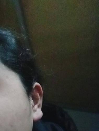 耳垂朝口是什么样的?我的耳垂是朝口还是外翻?