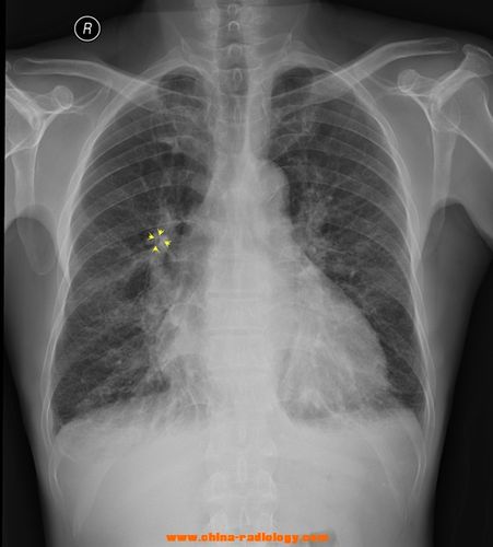 [心胸] 胸片135,间质性肺水肿,肺淤血?