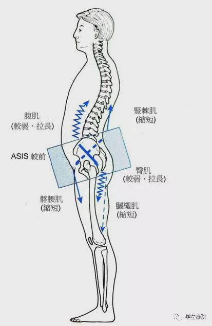 从下交叉综合症入手治疗下背痛