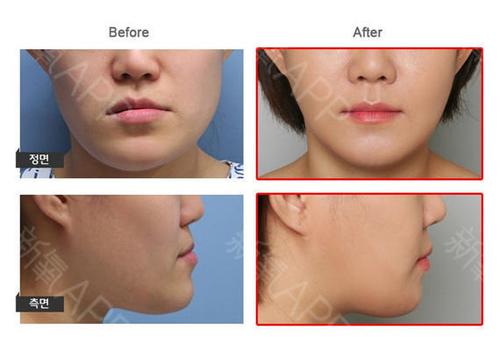 手术项目:地包天,上下嘴唇不对称