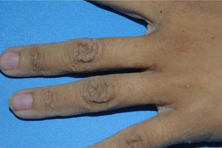 皮肤上的癌症密码之一:黑棘皮病