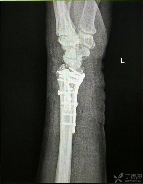 黄骨头桡骨远端骨折手术日记——桡骨远端陈旧性粉碎性骨折一例 [病例
