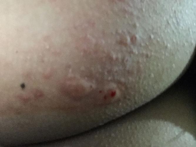 屁股上有好多豆豆 是什么来的?
