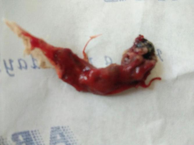 怀孕三十五天,药物流产