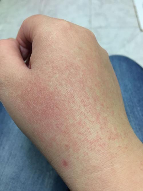 手背上起红斑,这是什么原因?