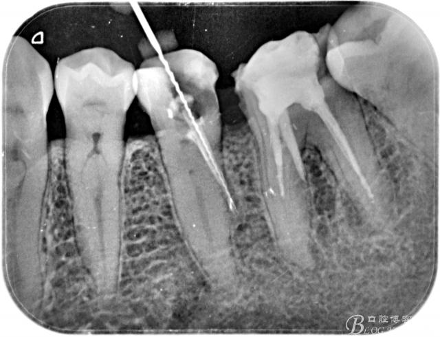 神奇的根管变异侧穿