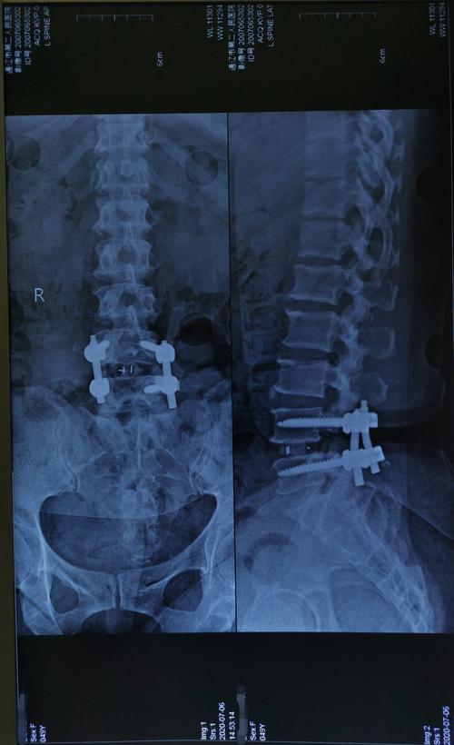 51岁腰椎间盘突出,黄韧带肥厚,椎管狭窄患者手术一例