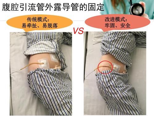 腹腔引流管外露导管固定法ppt